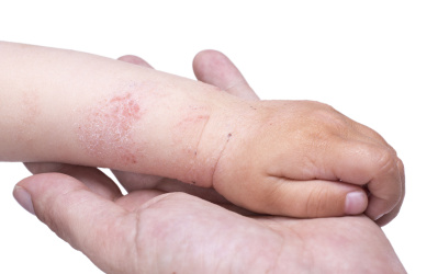 Trobada amb la pediatra: pell atòpica
