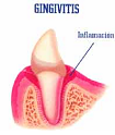 Vitamina D Gingivitis