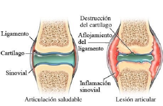 artritis, líquido sinovial, cartílago, inflamación articular, articulación