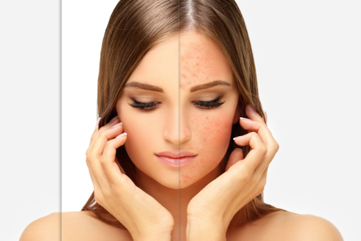 Rosácea: la enfermedad de los rubores en la piel