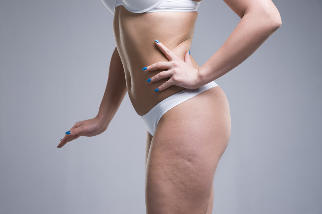 ¿Cómo eliminar la celulitis? 